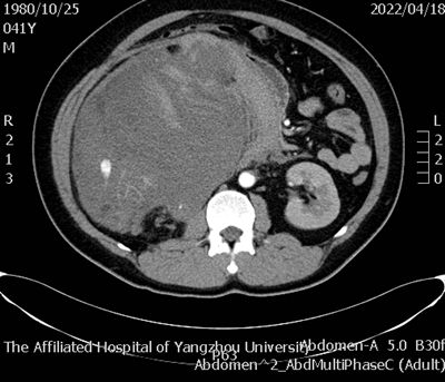 术前腹部增强CT_副本.png